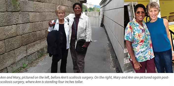 Ann Allen, before and after scoliosis surgery photos