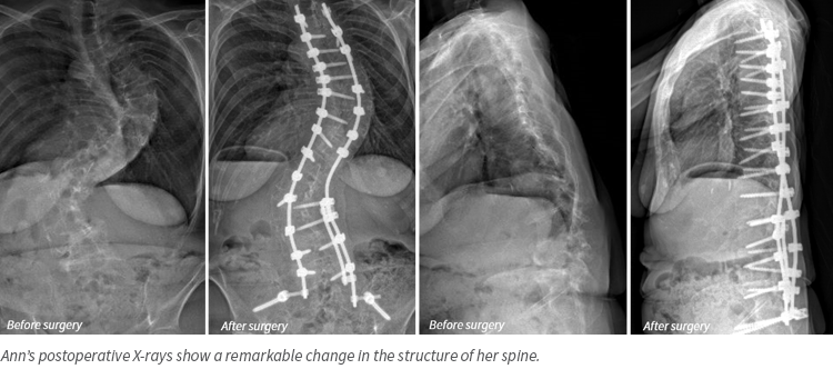 Ann Allen, X-rays from scoliosis surgery