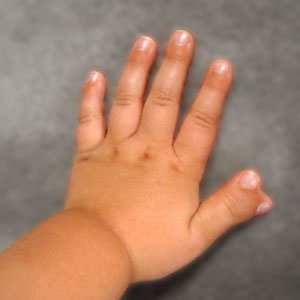 Radial Polydactyly