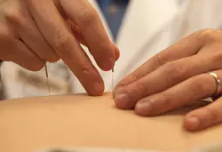 Patient with back pain receiving acupuncture procedure
