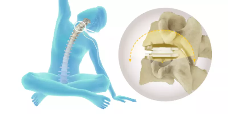 Medical illustration of total disc replacement surgery showing an artificial disc placed between vertebrae to preserve spinal motion.