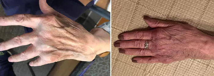 Pam's hands before and after surgery