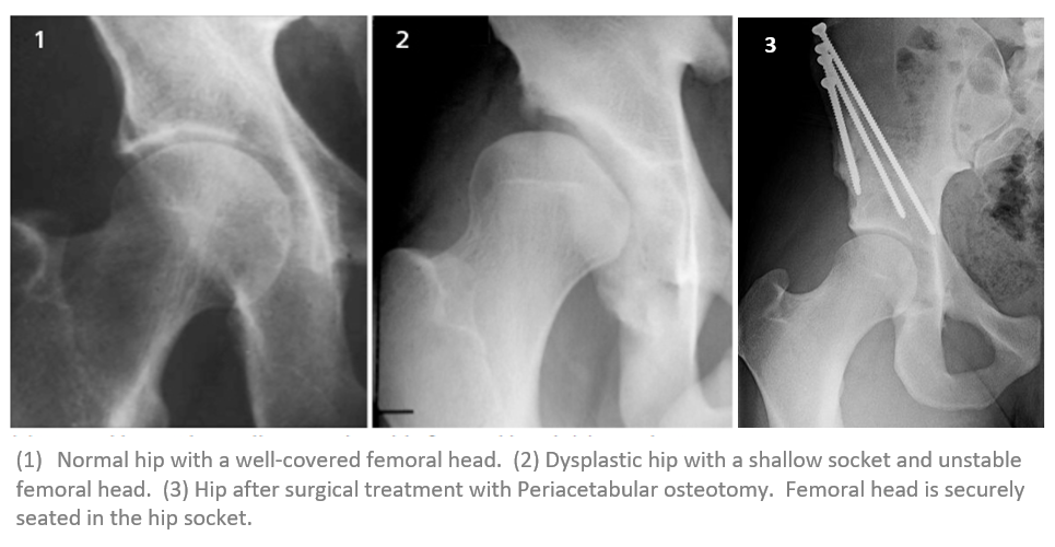 Periacetabular Osteotomy for Hip Dysplasia