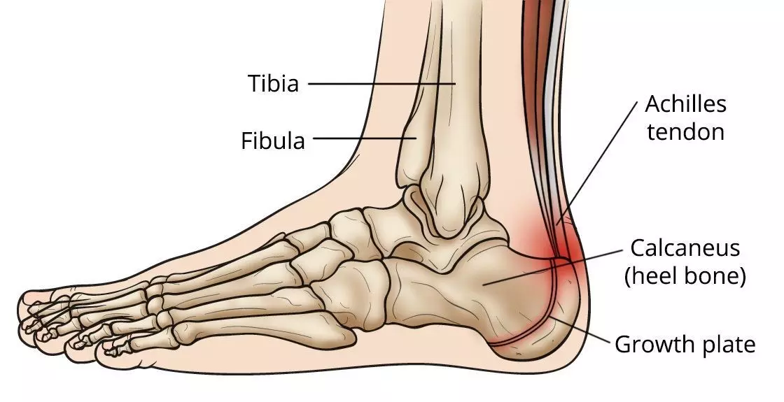 Sever's Disease, ankle and foot anatomy