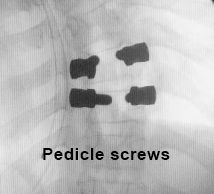 Shillla Rods Shilla Spine Procedure Q&A | Spine Doctors in St. Louis, MO
