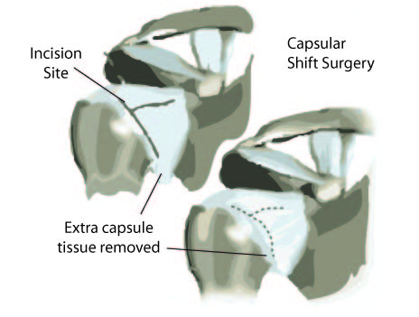 Surgical Treatment for Shoulder Instability