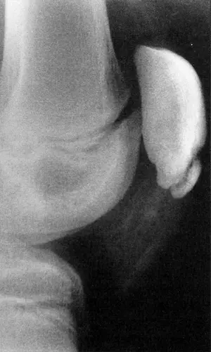 X-ray of Patellar Tendonitis, Sinding-Larson Johansson Disease